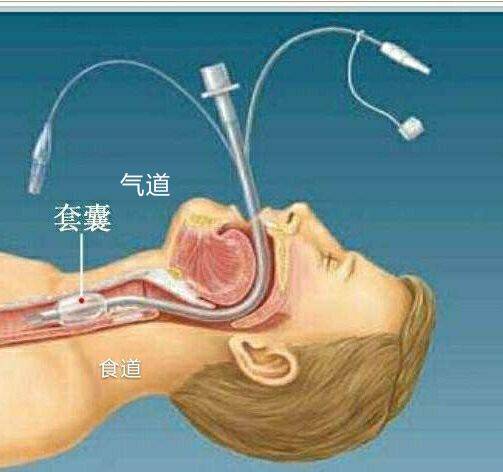可视喉镜气管插管步骤图片